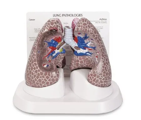 Nasco - Galloway Plastics - SB44894 - Lung Cancer Model Galloway Plastics