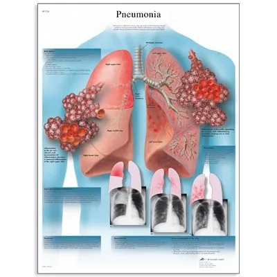 American 3B Scientific - From: VR1326L To: VR1326UU - Pneumonia Chart_EN_L
