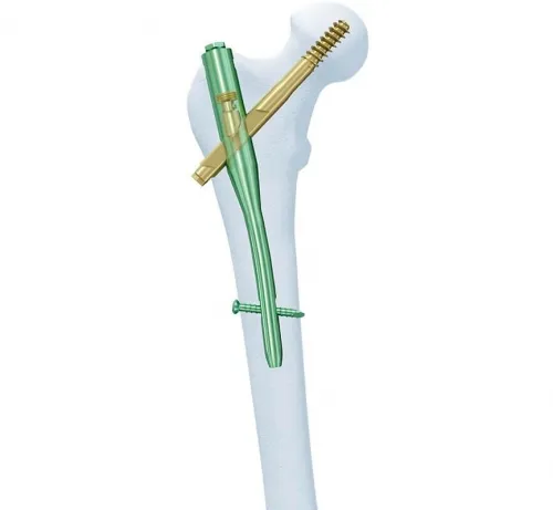 Synthes - 456.414S - SYNTHES 11MM/130° TI CANNULATED TROCHANTERIC FIXATION NAIL 340MM/RIGHT - STERILE